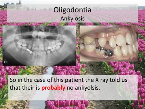 PPT - Oligodontia PowerPoint Presentation, free download - ID:1872529