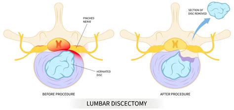 Discectomy Surgery Guide | Neurosurgery & Spine Consultants