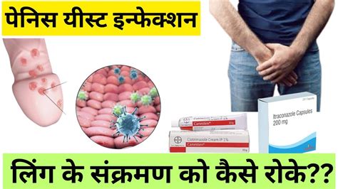 Penis Yeast Infection Treatment Causes And Medicine Yeast Infection