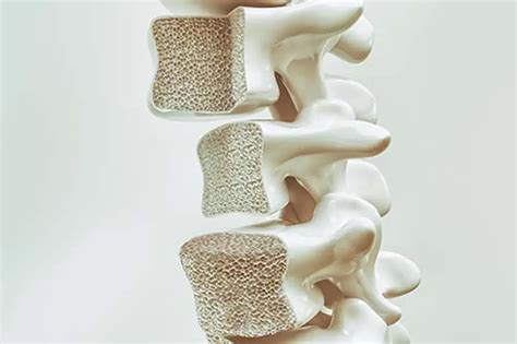 Osteoporosis Evaluation For Southlake Tx Southlake Endocrinology