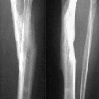 Preoperative Radiograph Showing A Complex Intraarticular Fracture Of