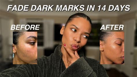 Can Anua Skincare Fade My Dark Marks Week Skin Transformation Youtube