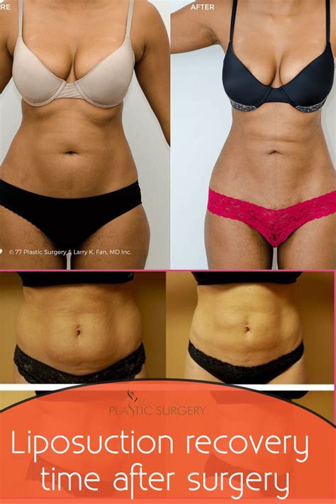 Liposuction Recovery Time After Surgery Liposuction Recovery