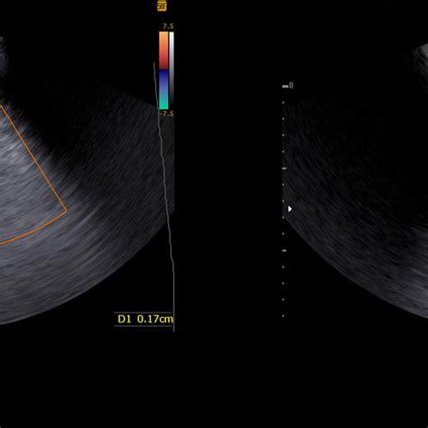 PDF A New Ultrasound Sign In The Diagnosis Of Pediatric Maxillary