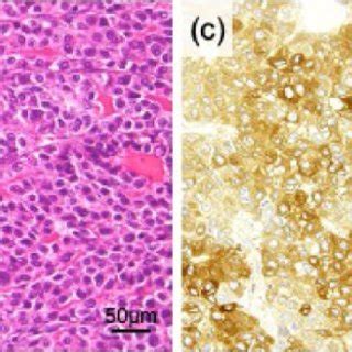 Representative Microscopic Images Of The Left Ovarian Tumor A B