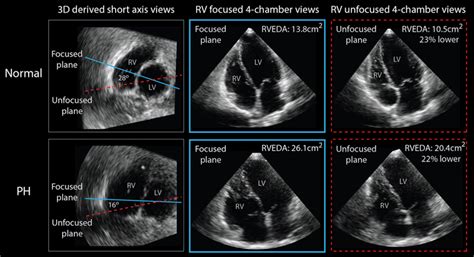 Example Of Right Ventricular Focused And Unfocused Apical 4 Chamber