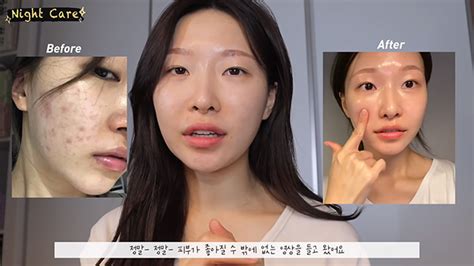 Korean Makeup Artist Reveals Glass Skin Routine If You Have Acne