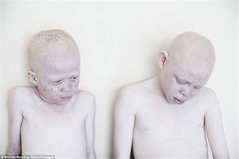 Albinos In Tanzania Who Face Being Killed For Body Parts Daily Mail Online