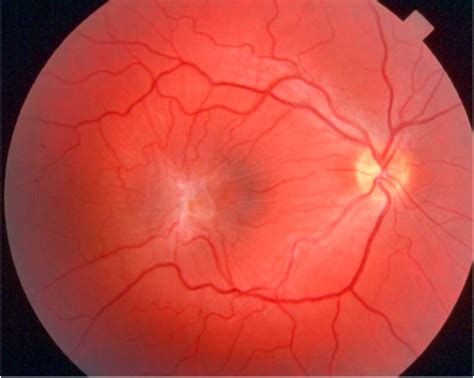 Epiretinal Membrane