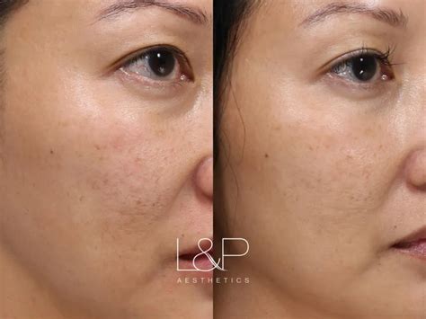 Microneedling Before And After Landp Aesthetics