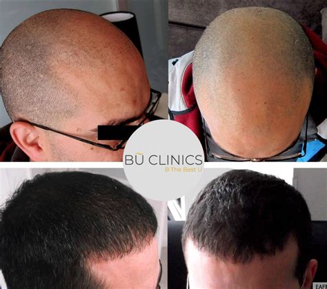 Before & After Hair Transplant – Bu Clinics | Be The Best You