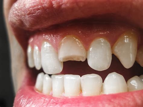 Can You Glue Broken Dentures At Thomas Meyers Blog