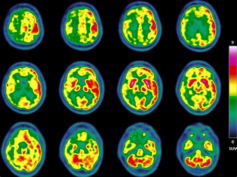 18F FDG PET CT In Sporadic Creutzfeldt Jakob Disease Clinical Nuclear