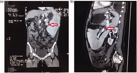 Abdominal Enhanced Computed Tomography And Computed Tomography