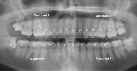 The Panoramic Dental Radiograph For Emergency Physicians Emergency Medicine Journal