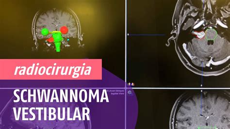 Radiocirurgia Neurinoma do Acústico ou Schwannoma Vestibular YouTube