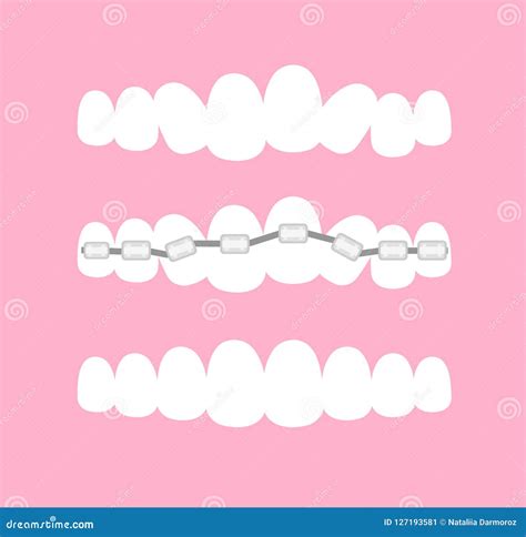 Stages Of Orthodontic Treatment Braces On Teeth Alignment Of Bite Of