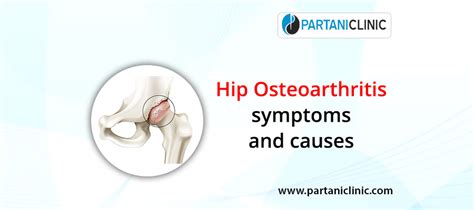 Hip osteoarthritis: symptoms and causes | Partani Clinic