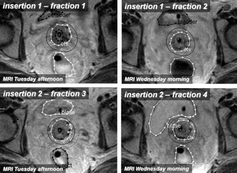 Uncertainty Analysis For 3D Image Based Cervix Cancer Brachytherapy By