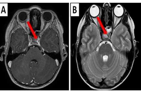 Brain Magnetic Resonance Imaging Mri Showing Sphenoid Sinusitis