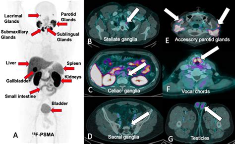 Pet Ct With F Psma In Patients With Prostate Cancer Review Of The