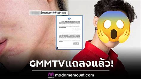 43 Share Tweet Share Gmmtv แถลงแล้ว สาวแฉโดนแฟนเก่าดาราค่ายดัง ทำร้ายจนกระดูกหัก หากผิดจริงใช้