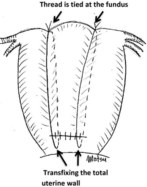 Uterine Compression Sutures For Postpartum Hemorrhage An Overview Matsubara 2013 Acta