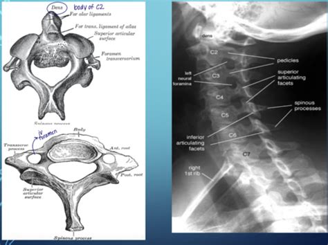 Clin Med Neuro Lecture 5 Imaging Of The Normal Abnormal Spine