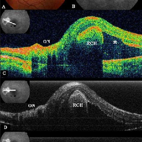 A Stratus Optical Coherence Tomography Oct Image Os Of Case