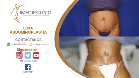 Cl Nica Imecip Lipoabdominoplastia Caso Youtube