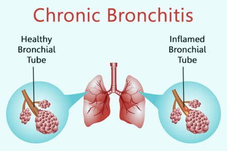 What Causes Chronic Bronchitis Why It Gets Worse At Night