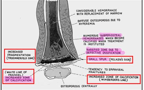 Mbd Osteomalacia Rickets Flashcards Quizlet