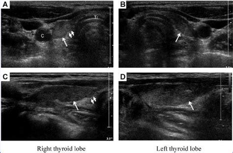 Transverse A B And Longitudinal C D Thyroid Ultrasonogram Images