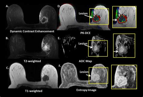 Integrated Radiomic Framework For Breast Cancer And Tumor Biology Using