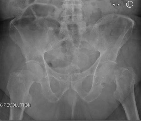 Femoral Neck Fracture - JETem