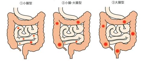 クローン病 北村医院