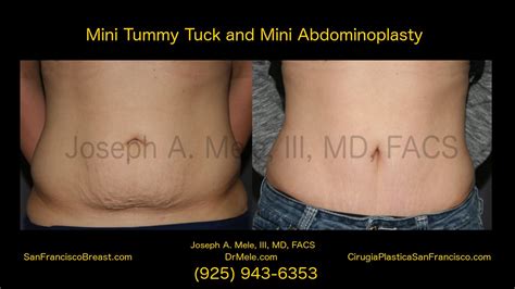 Mini tummy tuck before and after images - speclopers