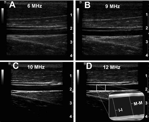 Ultrasound Assessment Of Flow Mediated Dilation Hypertension