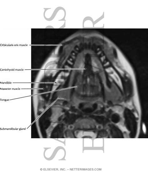 Floor Of Mouth Anatomy Coronal Ctr