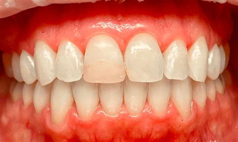 Composite Veneer To Fix A Broken Tooth Before And After Photos Austin Tx