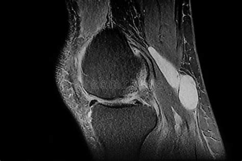 Nuclear Magnetic Resonance Of Right Knee That Shows Baker Cyst