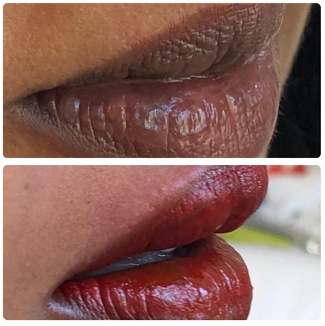 Album Semi Permanent Lip Natural Enhanced Beauty Clinic Leeds