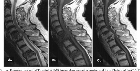 Figure 3 From Diagnosis And Management Of Adult Pyogenic Osteomyelitis