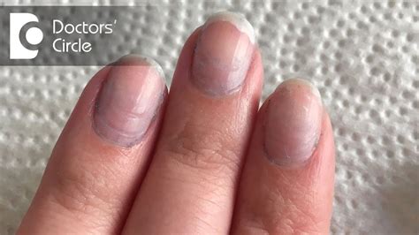 What Causes Purple Nails Nail Ftempo