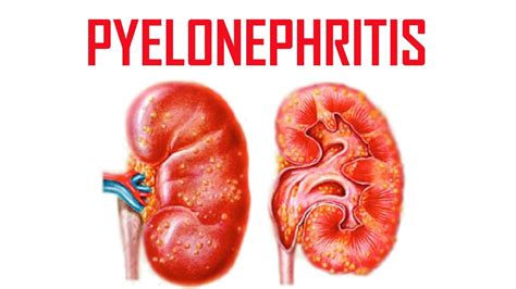 Pyelonephritis Causes Symptoms And Treatment