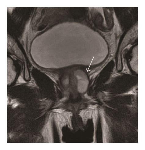 T2 Weighted Magnetic Resonance Image Of The Pelvis A Axial And B Download Scientific