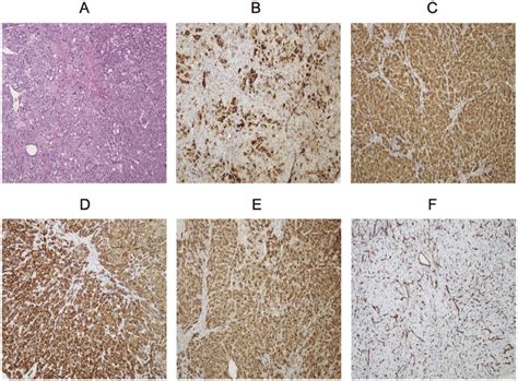 A Hepatocellular Carcinoma Composed Of Cells Exhibited An Download Scientific Diagram