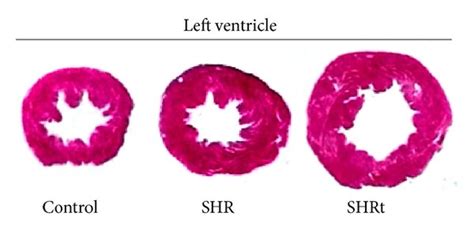 Exercise Training Improves Myocardial Contractility In Hypertensive