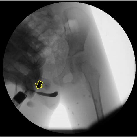 A Retrograde Urethrogram Showing A Penile Urethral Stricture Arrow Download Scientific Diagram