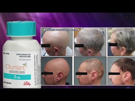 Fda Approves Landmark Drug Treatment For Alopecia Youtube